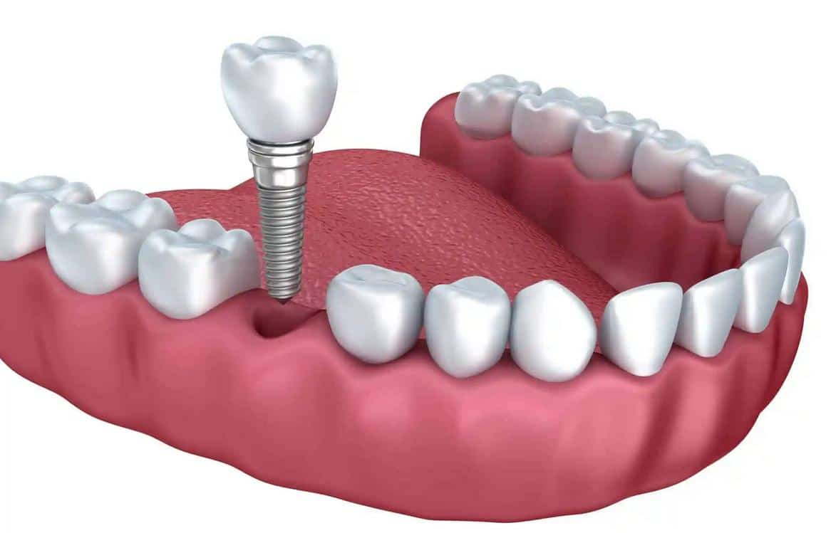 Протезирование зубов в казани. Имплантация жевательных зубов.