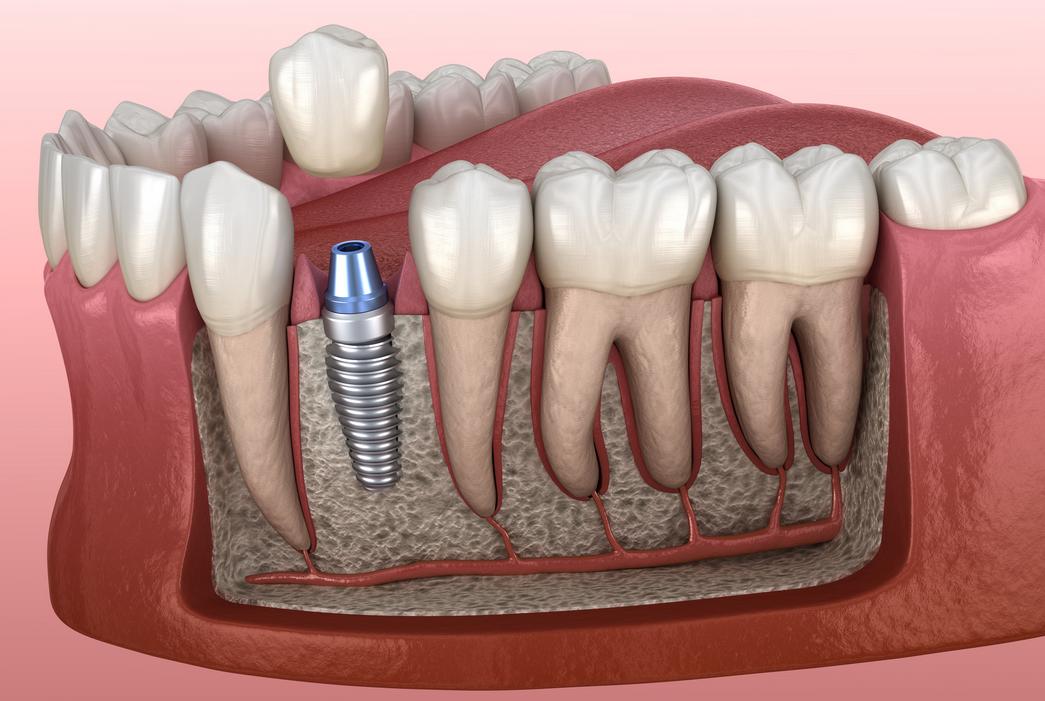 1. I risichi di implants dentali